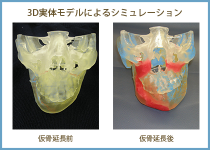 下顎の三次元仮骨延長